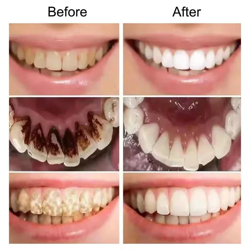 Clareador Dental – Sorriso Perfeito