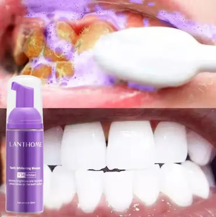 Clareador Dental – Sorriso Perfeito